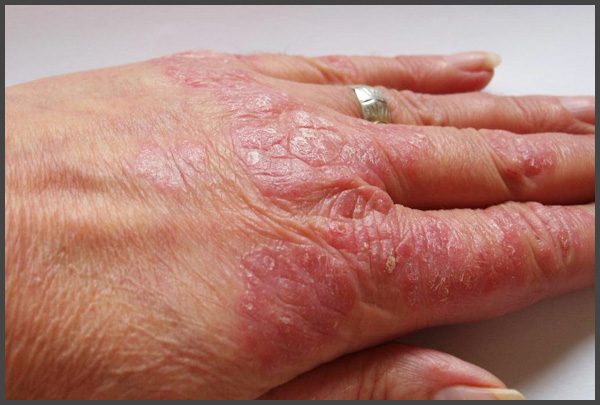 Psoriasis On Hands Pictures Psoriasis Expert
