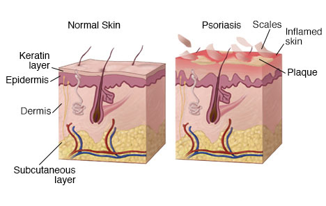 Causes of Psoriasis