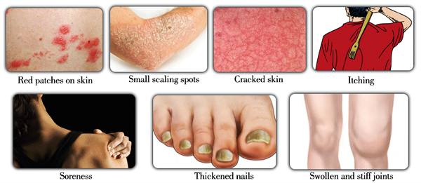 Signs and Symptoms of Psoriasis