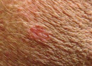 psoriasis in genital area pictures