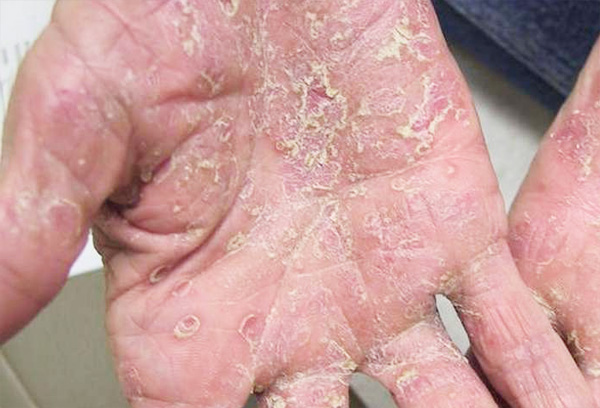 psoriasis pictures on hands