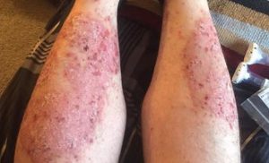 psoriasis pictures on legs