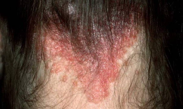 psoriasis scalp pictures