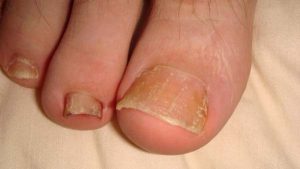 psoriasis toenails pictures