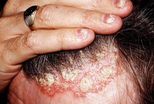 scalp psoriasis pictures
