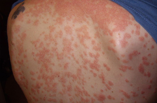 severe guttate psoriasis pictures