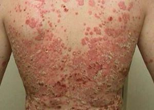 severe psoriasis pictures