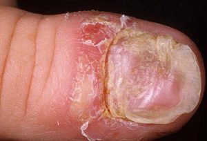 toenail psoriasis pictures