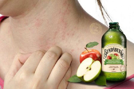 Apple cider vinegar for psoriasis