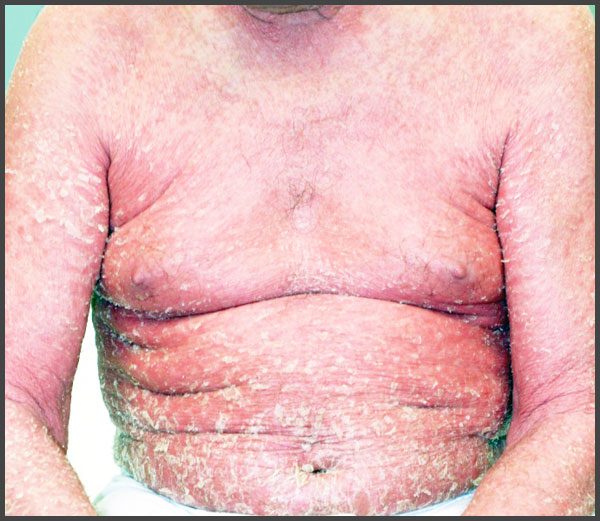Erythrodermic psoriasis pictures