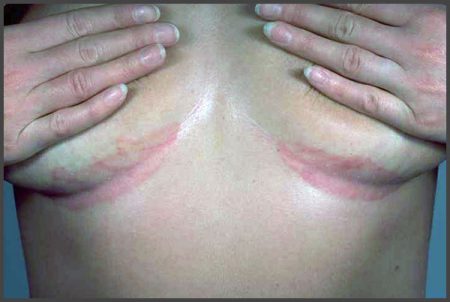 Inverse psoriasis under breasts pictures