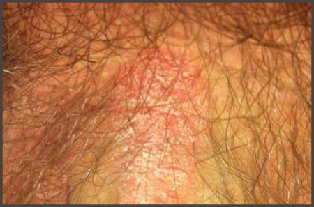 Male genital psoriasis pictures