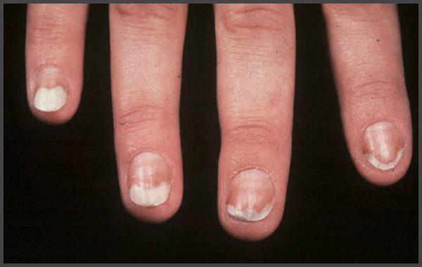 Nail psoriasis pictures