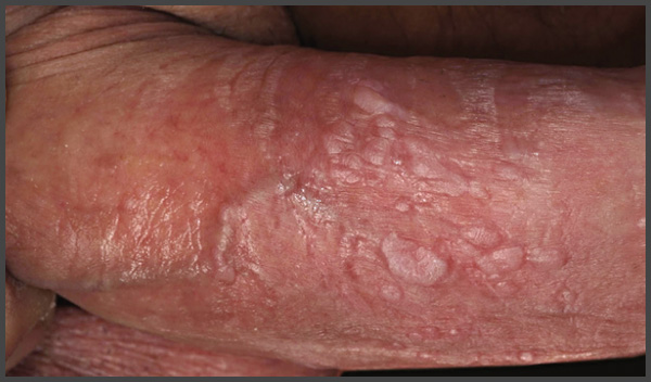 The appearance of rash or patches caused by penile psoriasis will vary depending on the type of psoriasis one is suffering from
