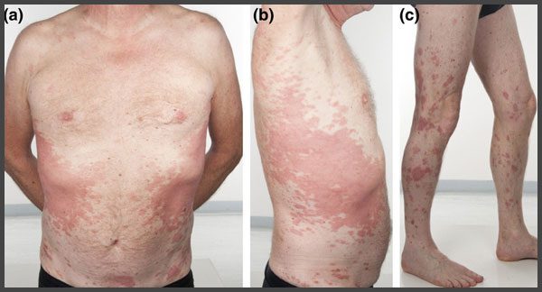 Pictures of Psoriasis