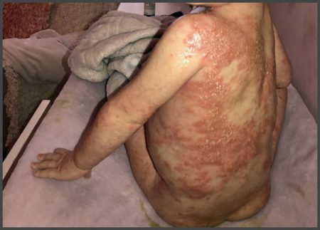 Pictures of psoriasis on kids