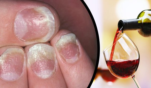 Psoriasis and alcohol