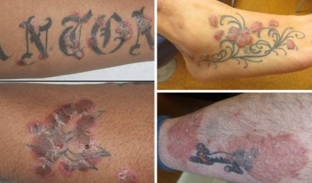 Psoriasis and tattoos