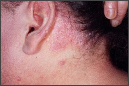 Psoriasis behind ears pictures