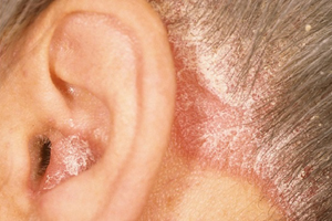 Psoriasis in ears