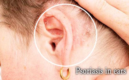 Psoriasis in ears