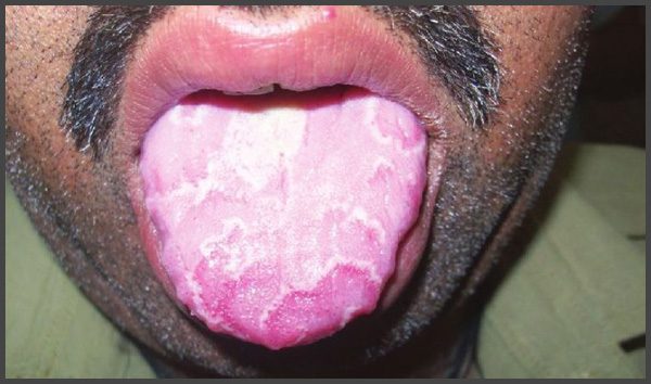 Psoriasis in mouth pictures