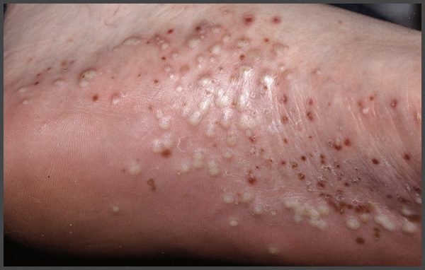 Psoriasis on feet pictures