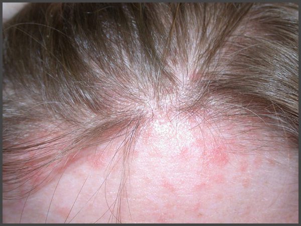 Psoriasis on forehead pictures
