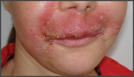 Psoriasis on lips pictures