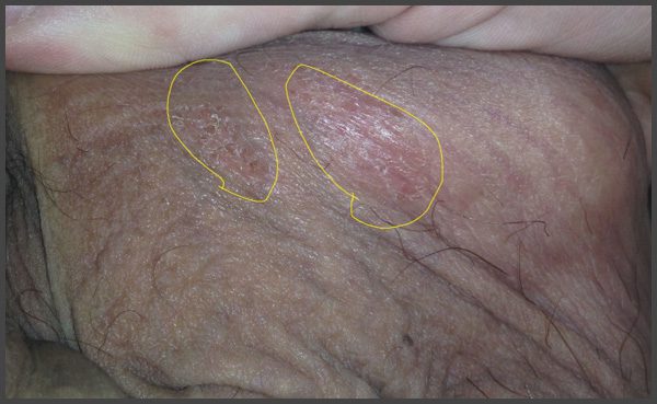 Psoriasis on testicles pictures