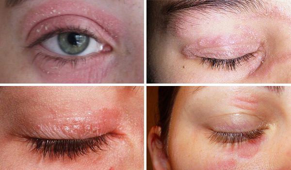 Treatment Psoriasis eyelids