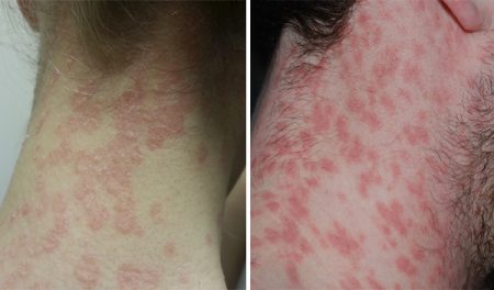 Treatment Psoriasis on the neck