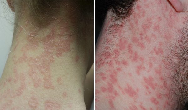 Treatment Psoriasis on the neck