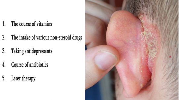 Treatment of psoriasis in the ears