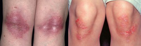 Treatment of psoriasis on the knees