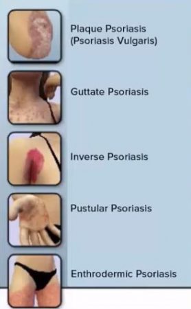 Types of psoriasis pictures