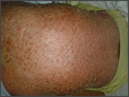 dry skin psoriasis pictures