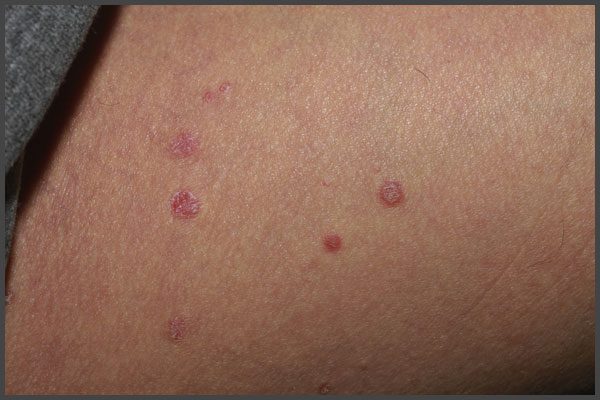 Early stages of psoriasis pictures
