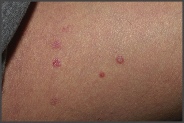 Early Stages Of Psoriasis Pictures Psoriasis Expert