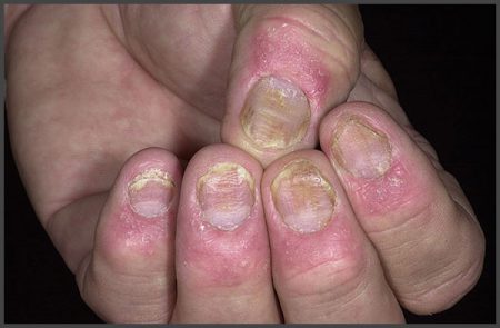 fingernails psoriasis pictures