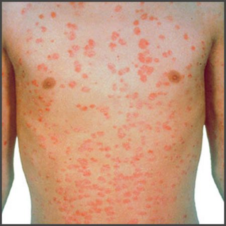 Guttate psoriasis pictures