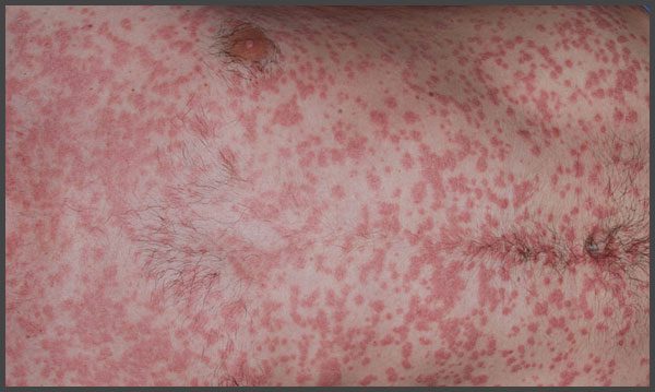 guttate psoriasis symptoms pictures