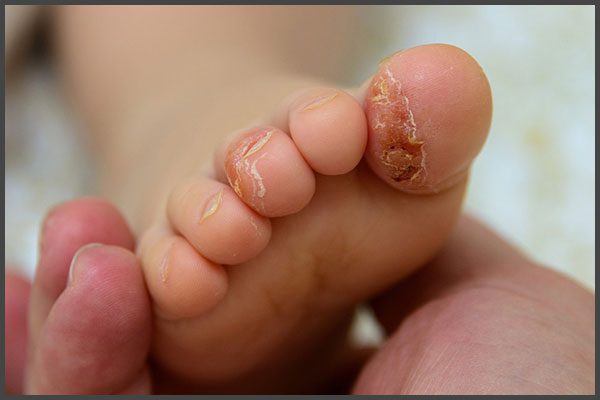 infant psoriasis pictures