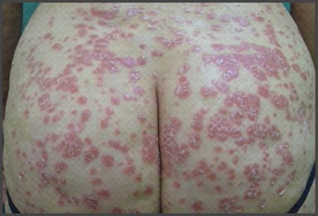 inverse psoriasis buttocks pictures
