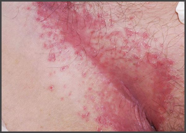 inverse psoriasis groin pictures