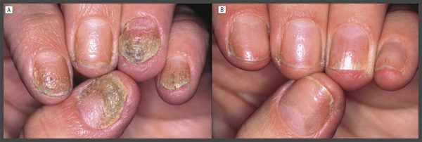 nail psoriasis pictures and treatments