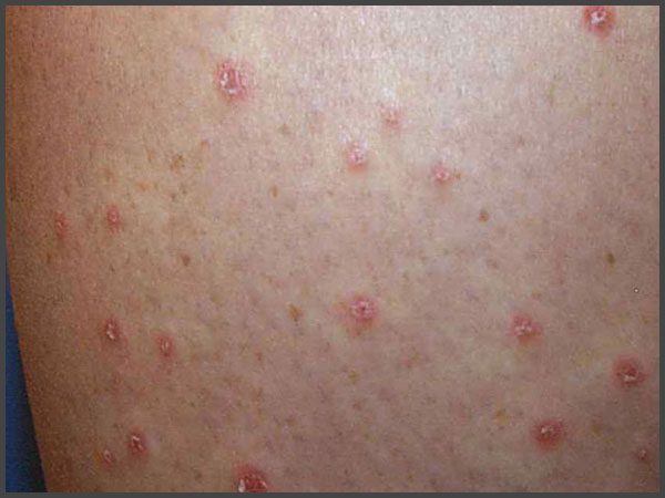 Perianal psoriasis pictures