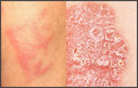 Pictures of eczema and psoriasis