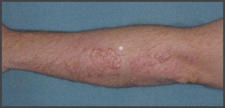 pictures of plaque psoriasis on arms