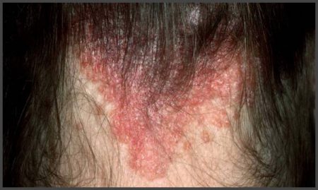 pictures of plaque psoriasis on scalp